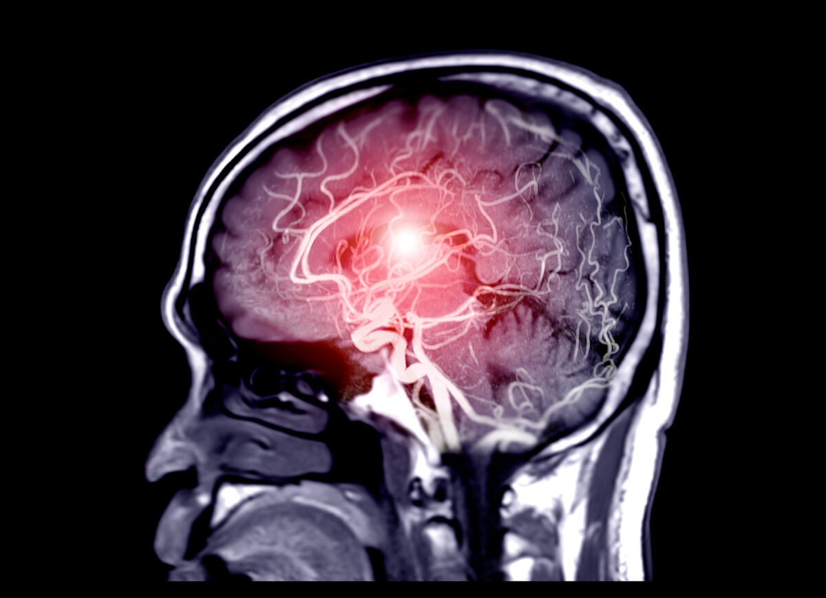 Científicos identifican nuevos subtipos de Esclerosis Múltiple a partir de escáneres de imagen por resonancia magnética
