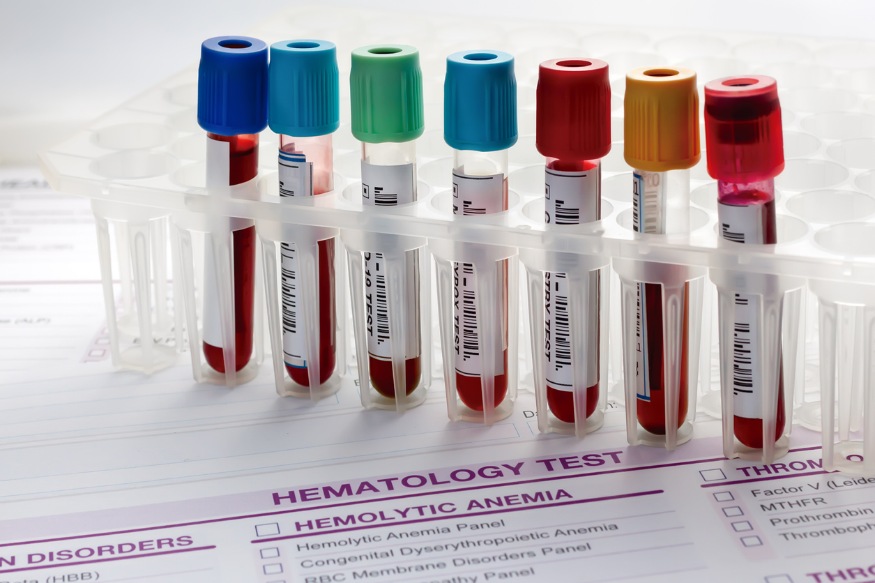 Nuevas pruebas de biomarcadores que ayudan a predecir la Esclerosis Múltiple